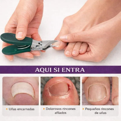NailFix™ — Corta uñas encarnadas y esquinas difíciles  de forma fácil